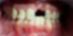 Odbudowa braków zębowych odcinka przedniego szczęki na koronach porcelanowych - zdjęcie przed zabiegiem.