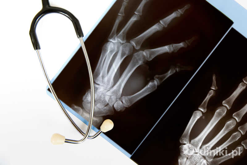 Zdjęcie rentgenowskie dłoni Zdjęcie rentgenowskie dłoni