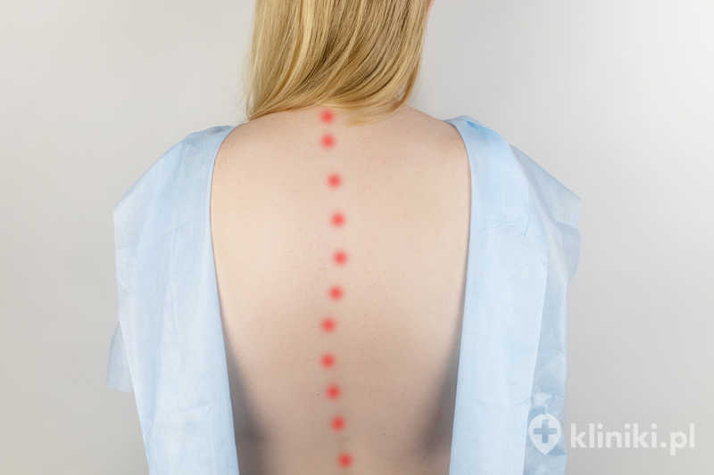 Terapia schorzeń kręgosłupa często opiera się na rehabilitacji, fizjoterapii oraz farmakoterapii przeciwbólowej Terapia schorzeń kręgosłupa często opiera się na rehabilitacji, fizjoterapii oraz farmakoterapii przeciwbólowej