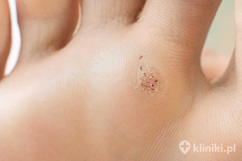 Brodawki wirusowe / kurzajki leczone laserem goją się zazwyczaj bez pozostawienia widocznych blizn Brodawki wirusowe / kurzajki leczone laserem goją się zazwyczaj bez pozostawienia widocznych blizn