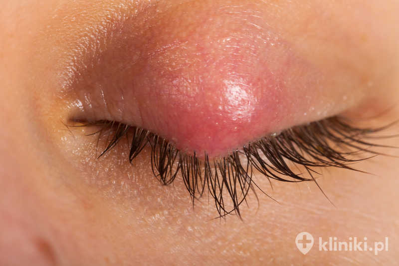 Drobne procedury chirurgiczne przeprowadzane są najczęściej w znieczuleniu miejscowym Drobne procedury chirurgiczne przeprowadzane są najczęściej w znieczuleniu miejscowym