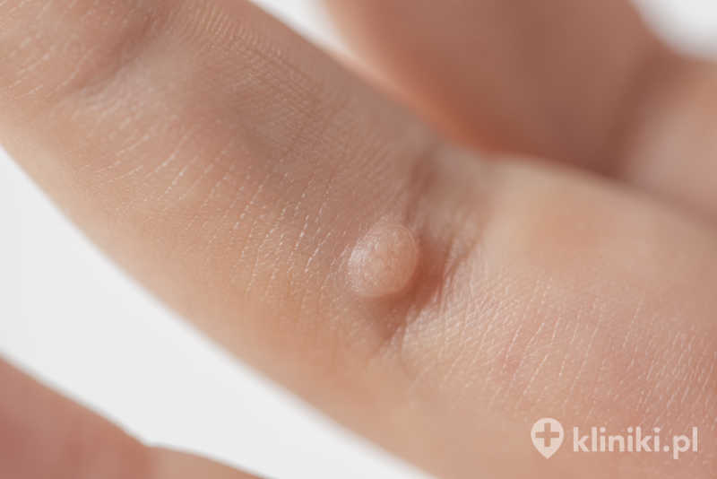 Kurzajki przed zabiegiem wymagają kwalifikacji przez lekarza Kurzajki przed zabiegiem wymagają kwalifikacji przez lekarza