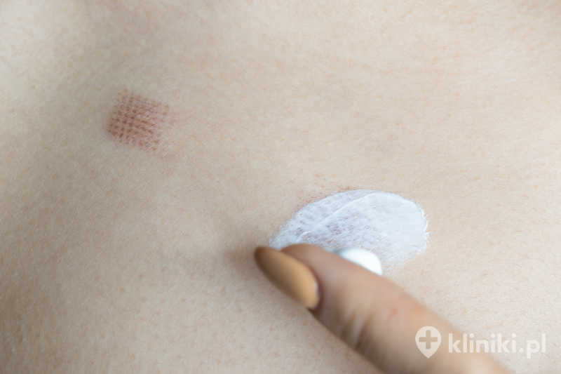 Laseroterapia zmian skórnych skraca czas gojenia i zmniejsza ryzyko powstania blizn Laseroterapia zmian skórnych skraca czas gojenia i zmniejsza ryzyko powstania blizn