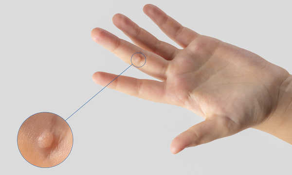 Laserowe usuwanie brodawek wirusowych / kurzajek jest szybkim zabiegiem wykonywanym w warunkach ambulatoryjnych Laserowe usuwanie brodawek wirusowych / kurzajek jest szybkim zabiegiem wykonywanym w warunkach ambulatoryjnych