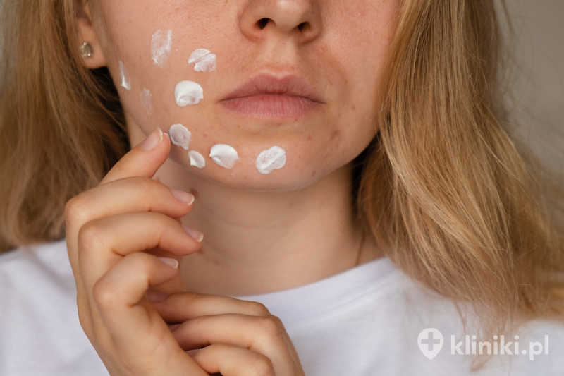 Laserowe usuwanie przebarwień skóry charakteryzuje się krótkim czasem rekonwalescencji i wysoką skutecznością Laserowe usuwanie przebarwień skóry charakteryzuje się krótkim czasem rekonwalescencji i wysoką skutecznością