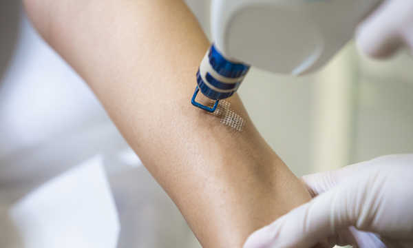 Laserowe usuwanie zmian skórnych to nowoczesna i małoinwazyjna metoda leczenia dermatologicznego Laserowe usuwanie zmian skórnych to nowoczesna i małoinwazyjna metoda leczenia dermatologicznego