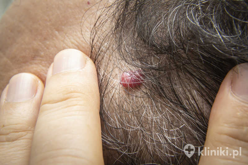 Laserowe usuwanie zmian skórnych wykonywane jest zwykle w znieczuleniu miejscowym Laserowe usuwanie zmian skórnych wykonywane jest zwykle w znieczuleniu miejscowym