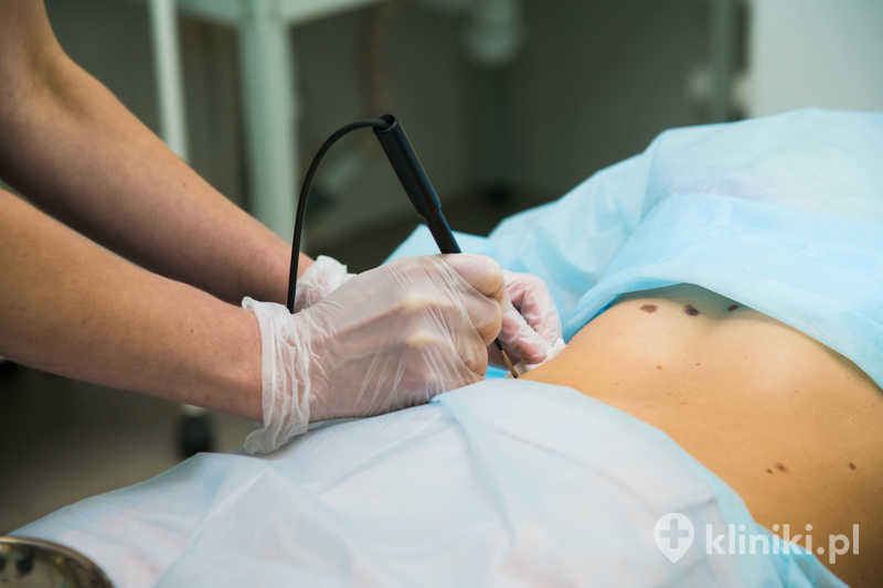 Procedura usuwania znamion barwnikowych i pieprzyków laserem jest szybka i małoinwazyjna Procedura usuwania znamion barwnikowych i pieprzyków laserem jest szybka i małoinwazyjna