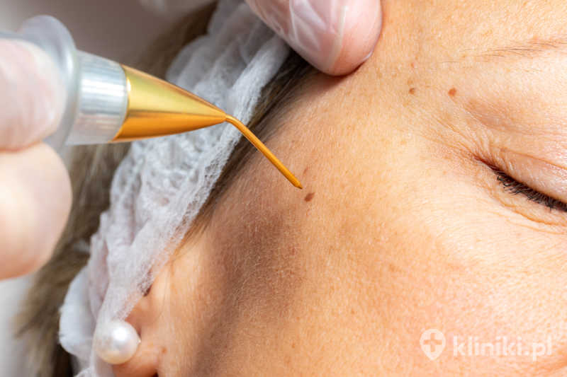 Zabieg laserowego usuwania zmian skórnych pozwala na precyzyjne usunięcie zmiany z minimalnym uszkodzeniem tkanek Zabieg laserowego usuwania zmian skórnych pozwala na precyzyjne usunięcie zmiany z minimalnym uszkodzeniem tkanek