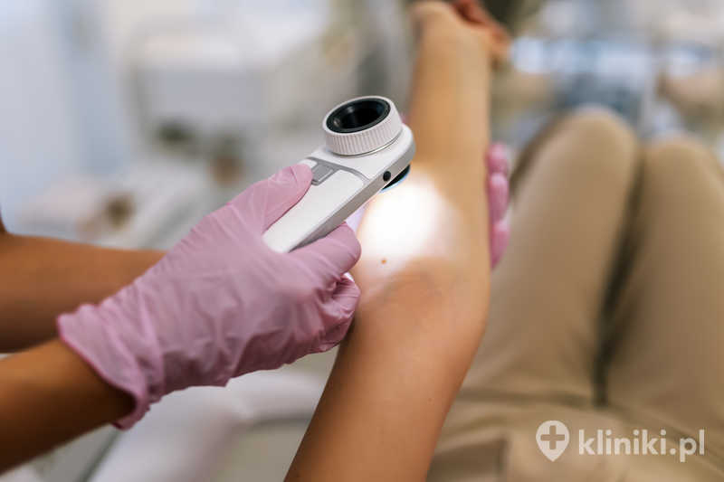 Znamiona barwnikowe i pieprzyki usuwane laserem wymagają wcześniejszej oceny dermatologicznej Znamiona barwnikowe i pieprzyki usuwane laserem wymagają wcześniejszej oceny dermatologicznej