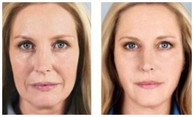 Wypełnienia i modelowanie wolumetryczne twarzy przed i po zabiegu