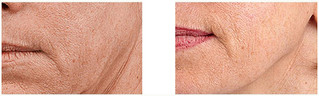 Mezoterapia - odmładzanie i rewitalizacja skóry przed i po zabiegu