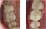 Stomatologia zachowawcza przed i po zabiegu