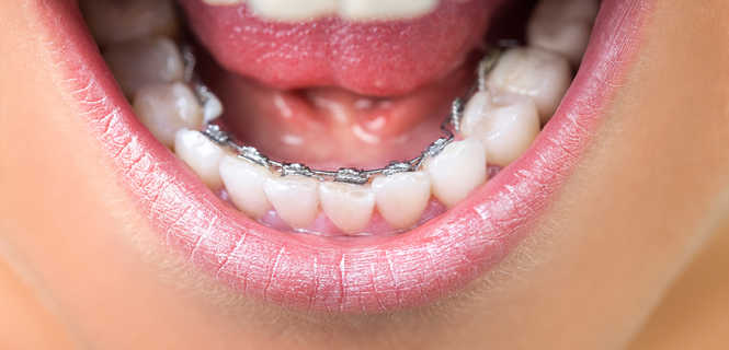 Aparat lingwalny - dyskretne i efektywne leczenie ortodontyczne